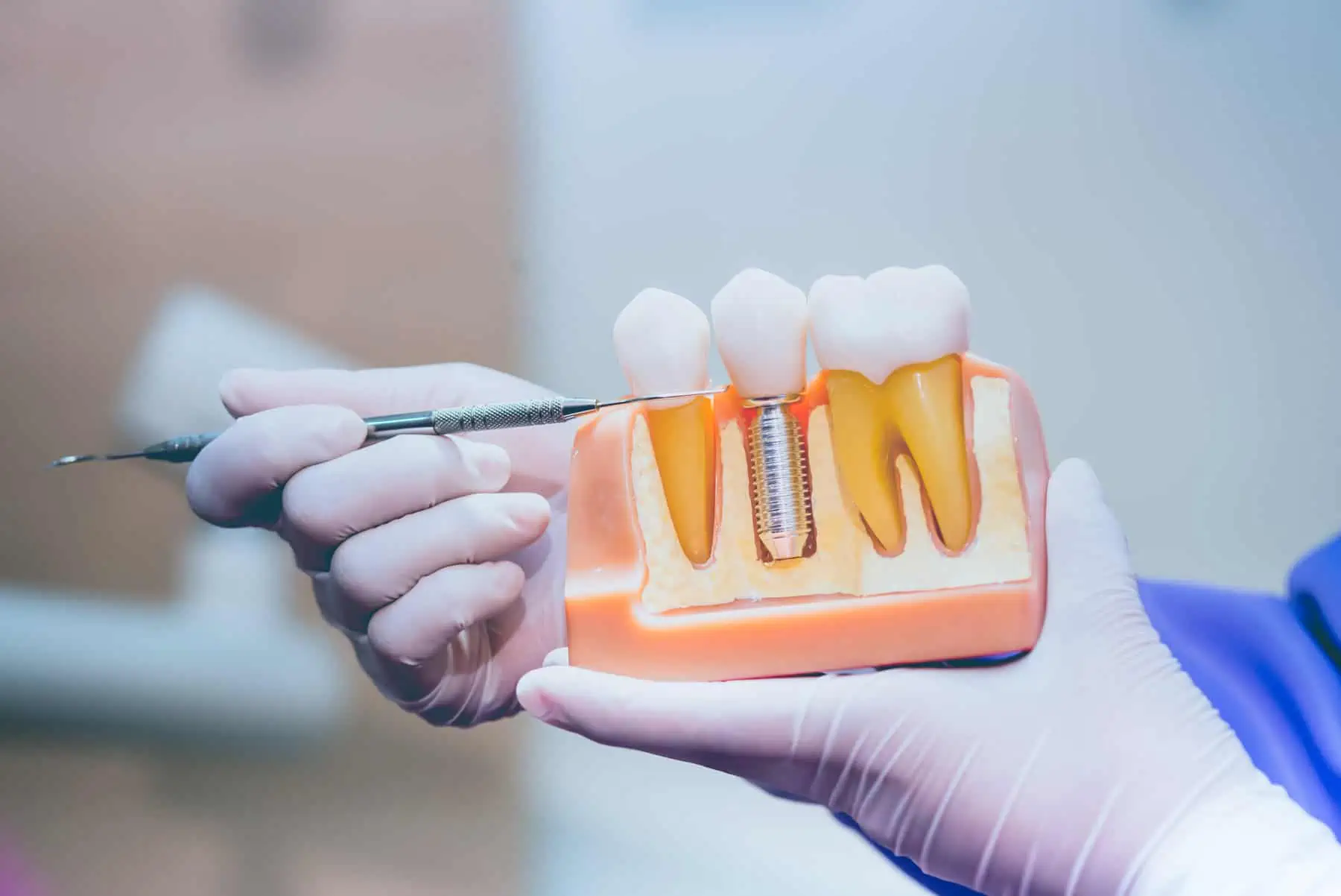 Tooth Replacement Options in Purcellville, VA
