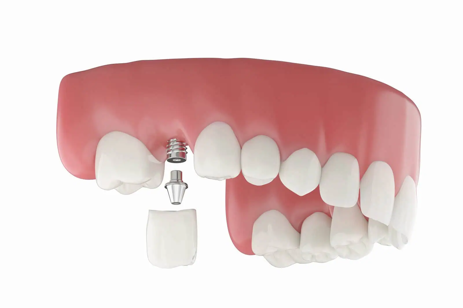 Implant cost consultation with billing coordinator